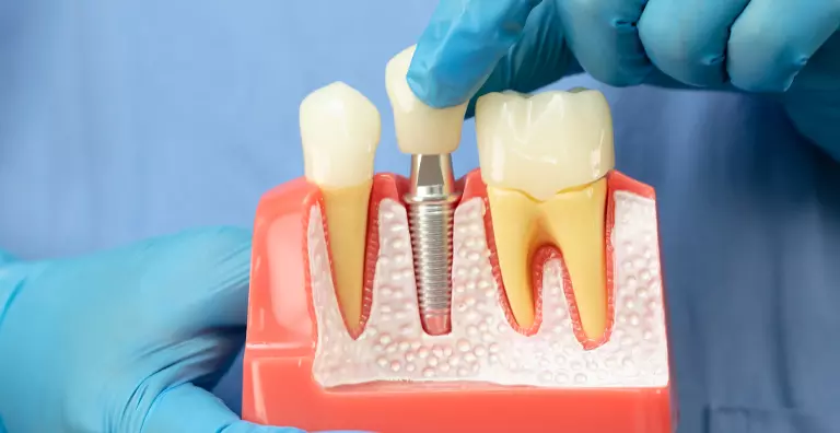 Dental Implant