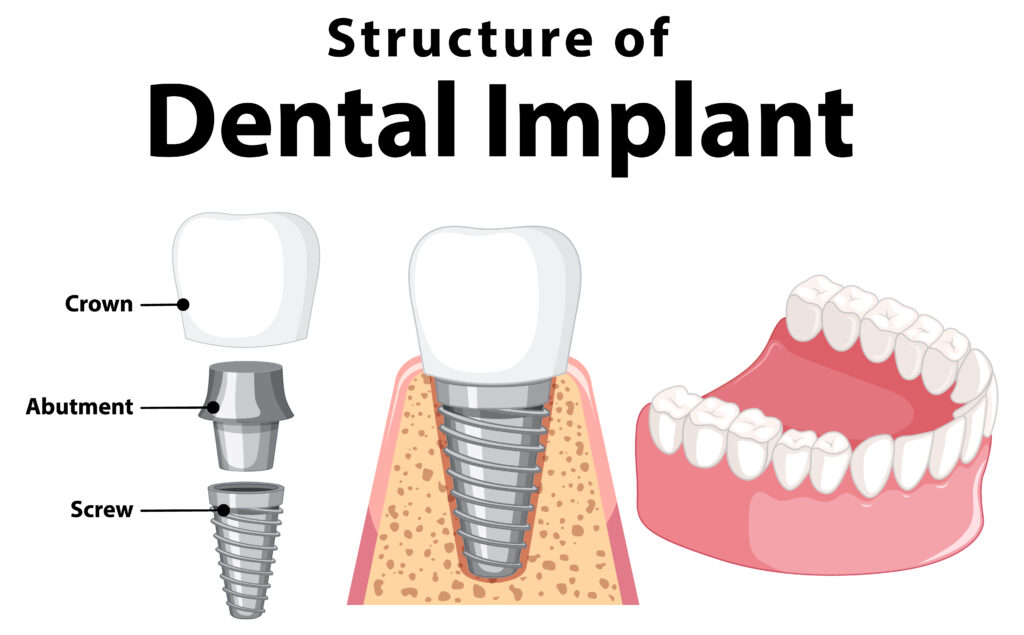 structure of the dental implant