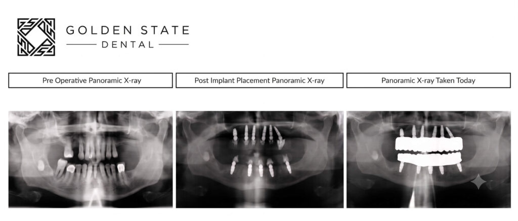 Full mouth implants