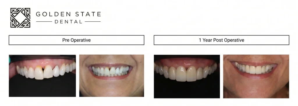 Crown Lengthening