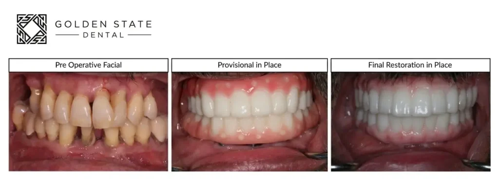 implant dentist golden