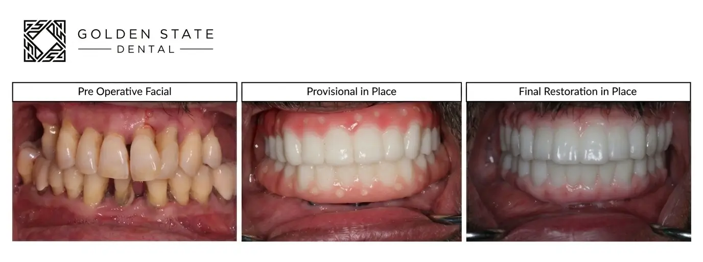 Dentures vs. Implants: A Complete Cost-Effectiveness and Lifestyle Comparison