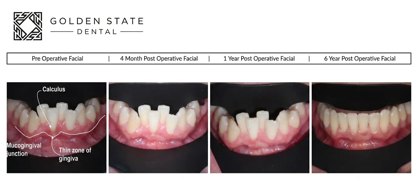 Why Your Orthodontist Requires a Periodontal Clearance: The Risks of Braces on Unhealthy Gums