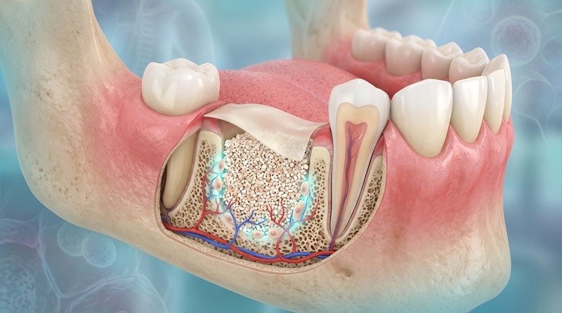 Dental Bone Regeneration